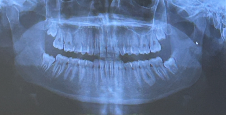 X-ray taken prior to wisdom teeth removal.